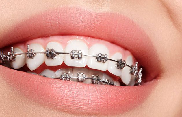 ortodoncia frenillos brackets equilibrio morfológico y funcional de la boca