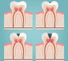 periodoncia_etapas_dentista